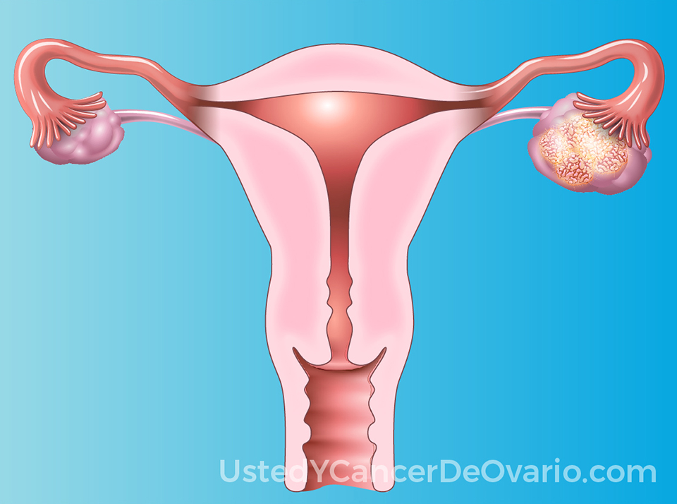 Infórmese sobre diversos temas relacionados con el cáncer de ovario a través de animaciones cortas