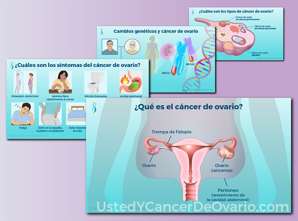 Acceda a presentaciones de diapositivas visuales e informativas sobre el cáncer de ovario