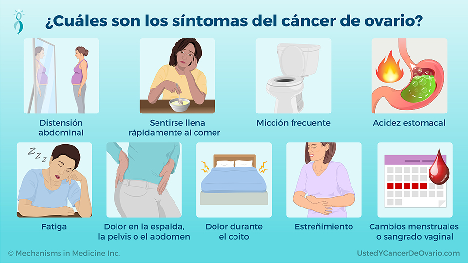 ¿Cuáles son los síntomas del cáncer de ovario?