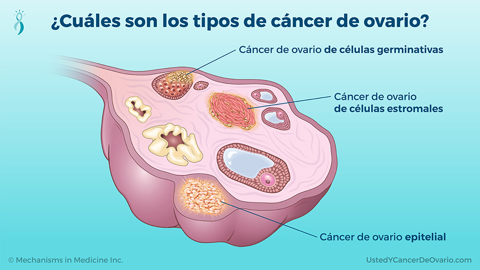 ¿Cuáles son los tipos de cáncer de ovario?