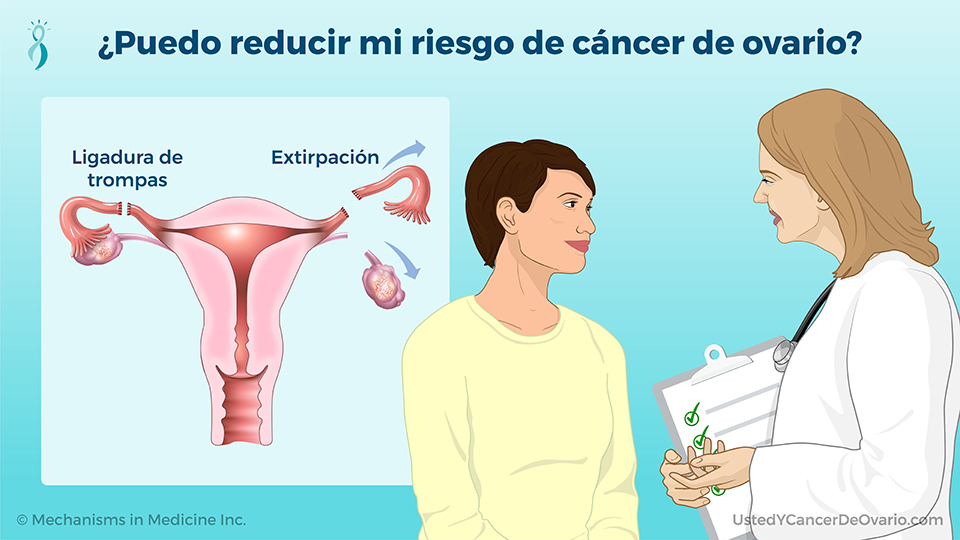 ¿Puedo reducir mi riesgo de cáncer de ovario?