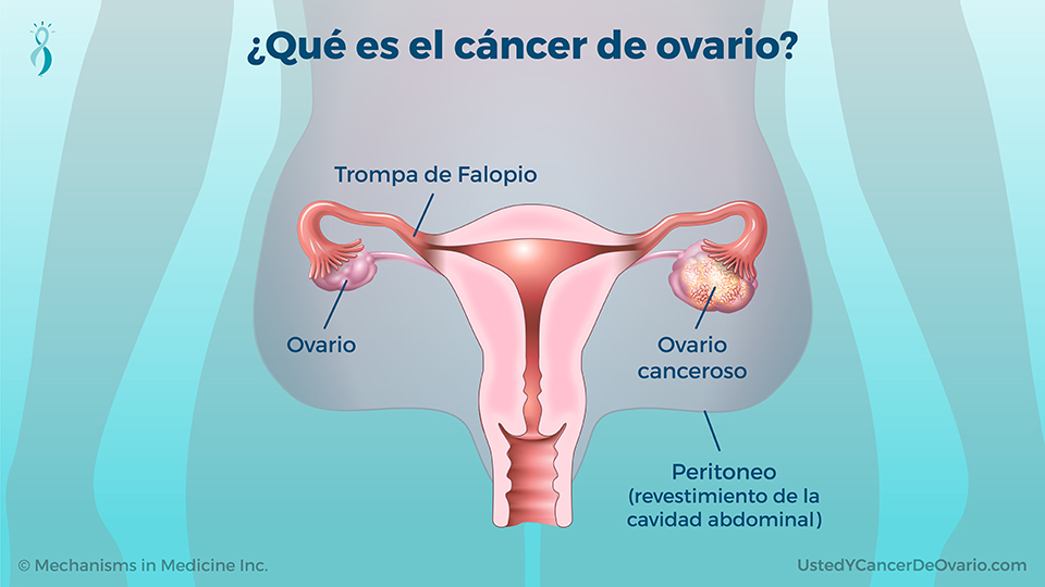 ¿Qué es el cáncer de ovario?