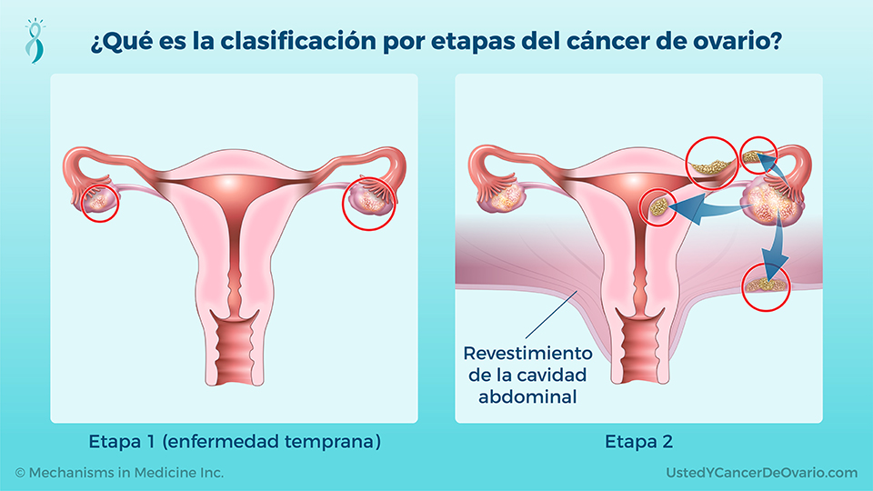¿Qué es la clasificación por etapas del cáncer de ovario?