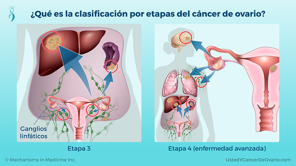 ¿Qué es la clasificación por etapas del cáncer de ovario?