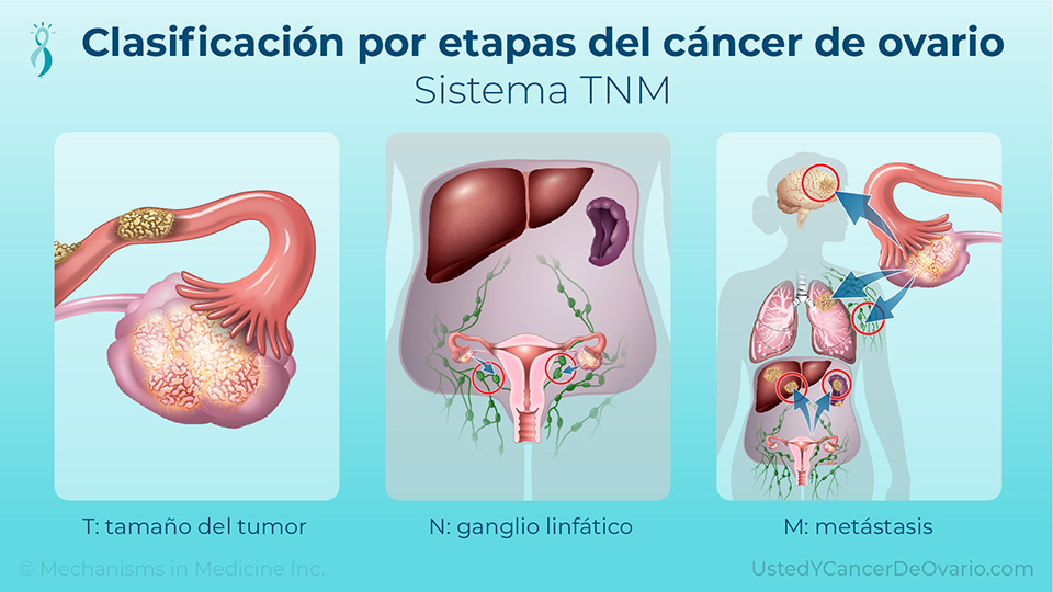 Clasificación por etapas del cáncer de ovario (Sistema TNM)