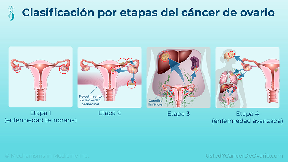 Clasificación por etapas del cáncer de ovario