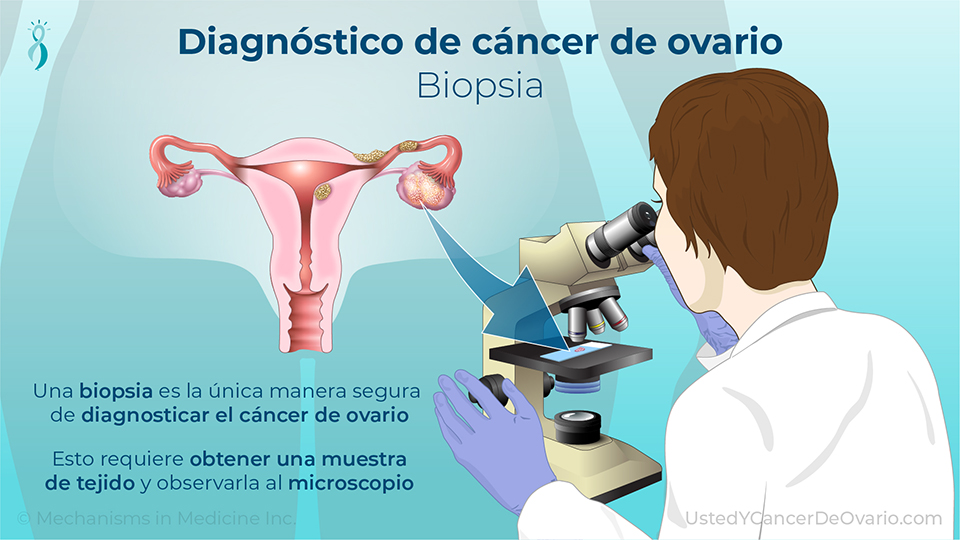 Diagnóstico de cáncer de ovario (Biopsia)