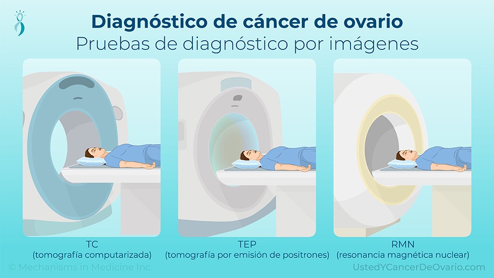 Diagnóstico de cáncer de ovario (Pruebas de diagnóstico por imágenes)