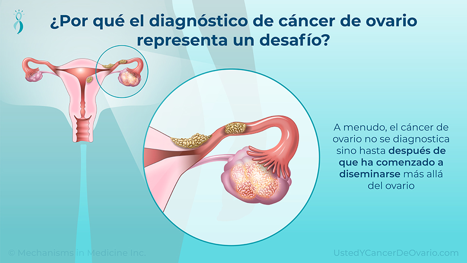 ¿Por qué el diagnóstico de cáncer de ovario representa un desafío?