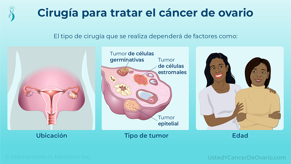 Cirugía para tratar el cáncer de ovario