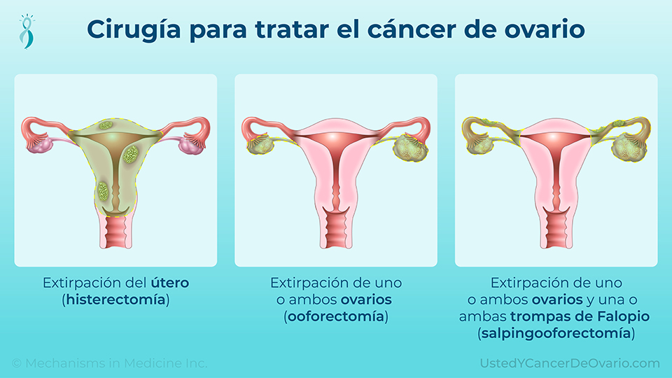 Cirugía para tratar el cáncer de ovario
