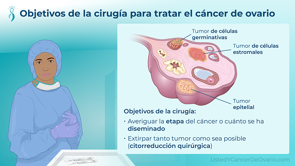Objetivos de la cirugía para tratar el cáncer de ovario