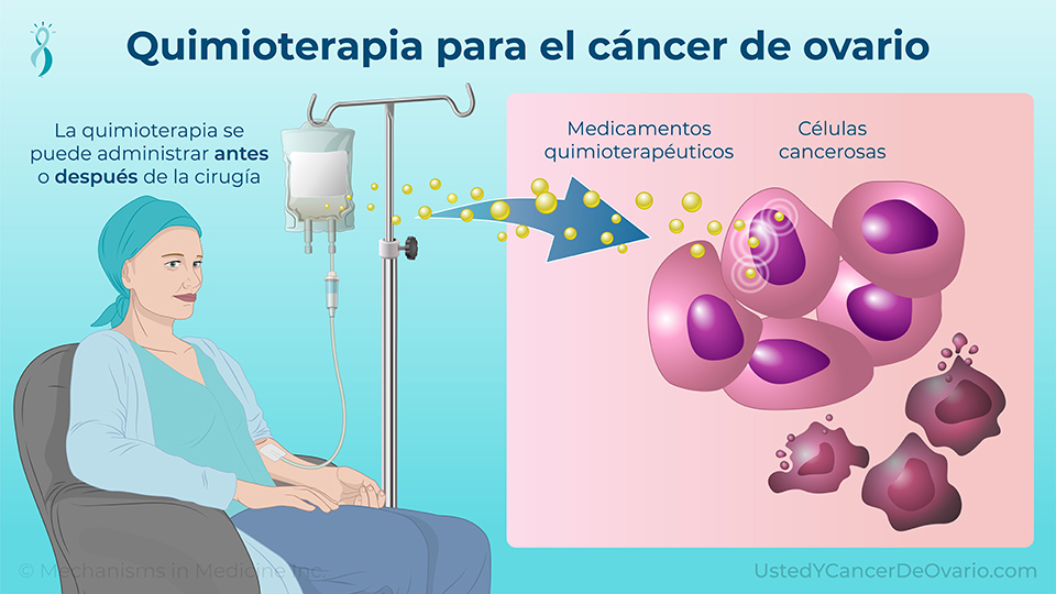 Quimioterapia para el cáncer de ovario