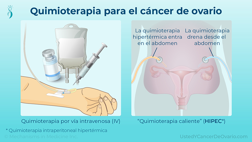 Quimioterapia para el cáncer de ovario